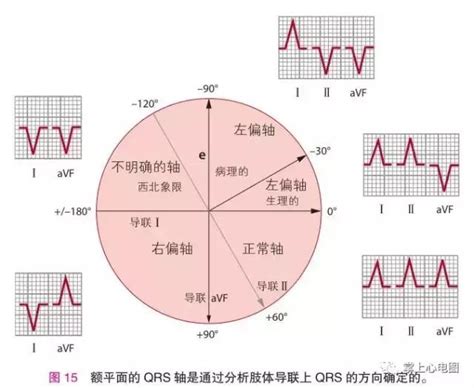 逆時針|心電圖報告解析：逆時針旋轉與右心房肥大的影響及處理方式